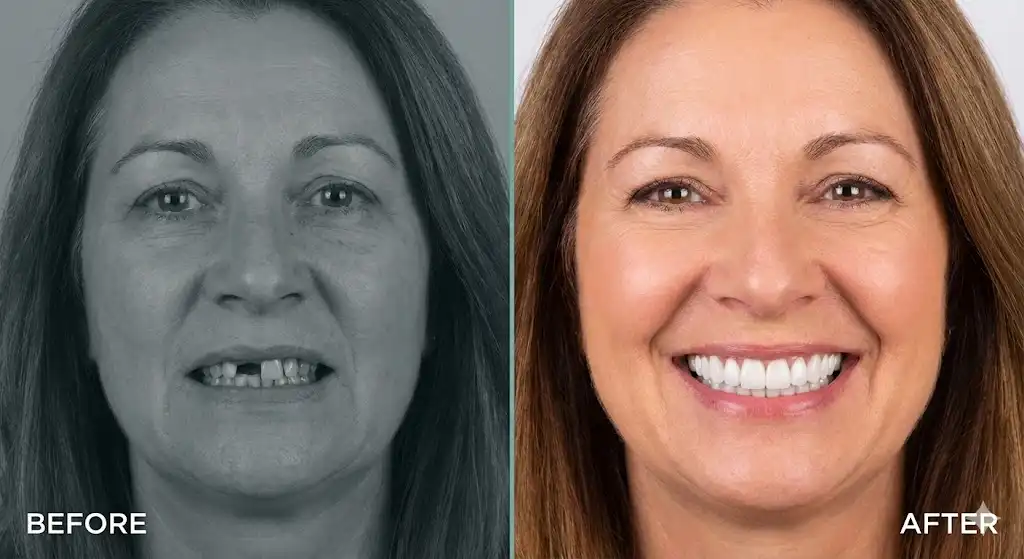[A split-screen "before and after" photograph of a dental patient transformation.] The left side, in muted tones labeled "BEFORE," shows a patient with missing teeth. The right side, in vibrant color labeled "AFTER," shows the same patient with a flawless, complete smile, illustrating the results driven by high-intent keywords.